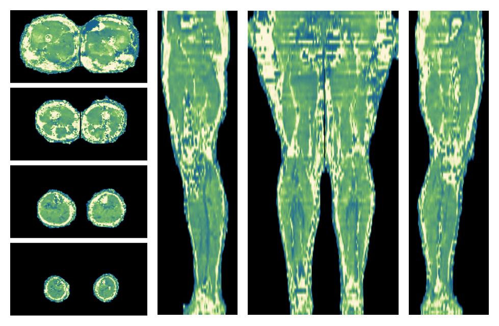 The water only T2 relaxation time of the lower extremity obtained from multi echo spin echo t2 mapping with EPG based reconstruction.