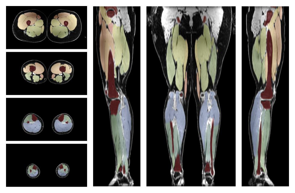 Overlay of automated muscle segmentation labels on dixon water image.