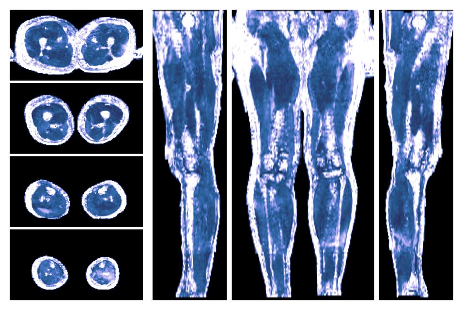 IVIM corrected whole leg muscle fractional anisotropy obtained from diffusion tensor imaging.