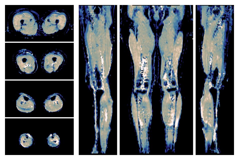 IVIM corrected whole leg muscle mean diffusivity obtained from diffusion tensor imaging.