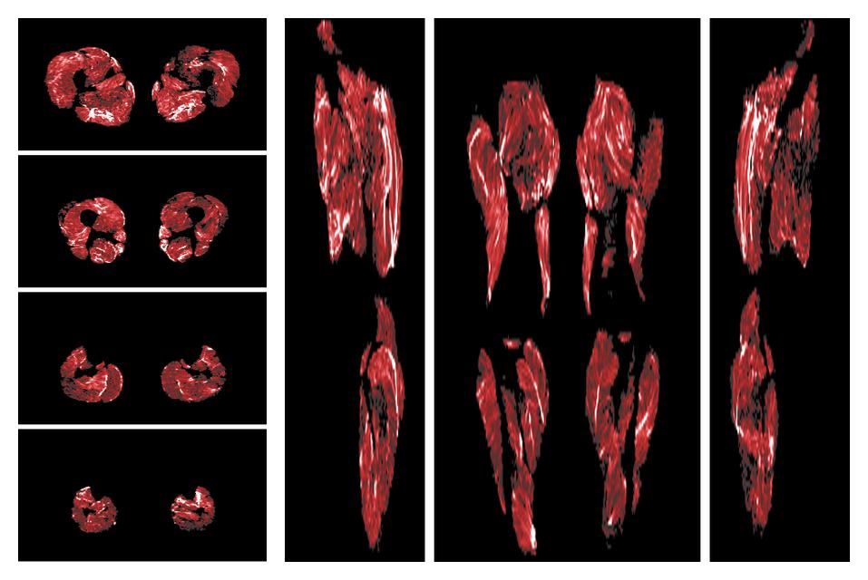 Muscle fiber tract density map based on whole leg DTI based fiber tractography.