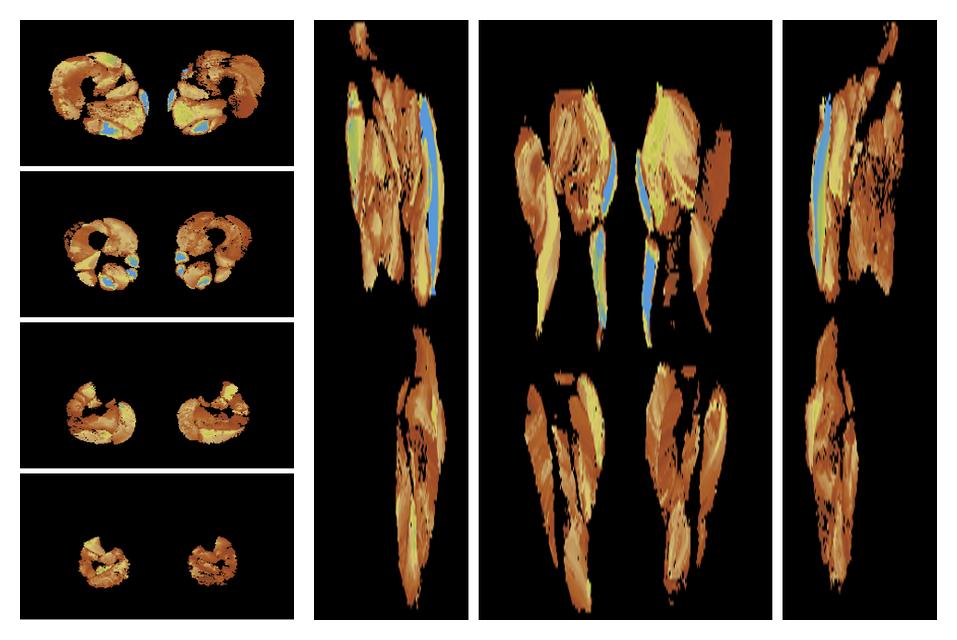 Muscle fiber tract length map based on whole leg DTI based fiber tractography.