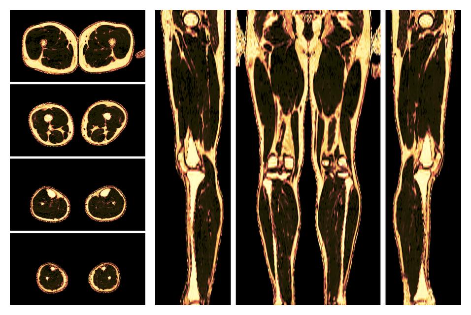 The fat fraction of the lower extremity obtained from the dixon reconstruction for muscle water fat quantification.