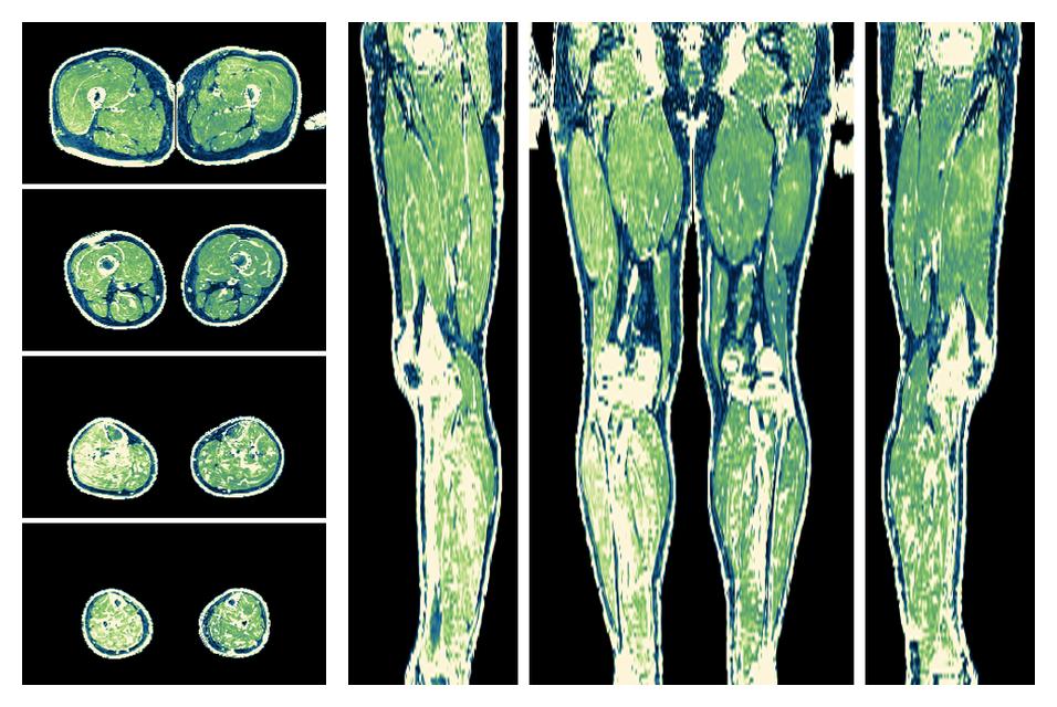 The R2 star relaxation time of the lower extremity obtained from the dixon reconstruction for muscle water fat quantification.