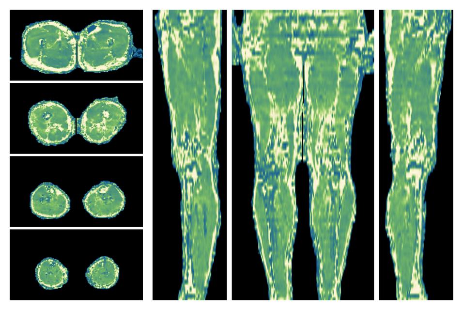 The water only T2 relaxation time of the lower extremity obtained from multi echo spin echo t2 mapping with EPG based reconstruction.