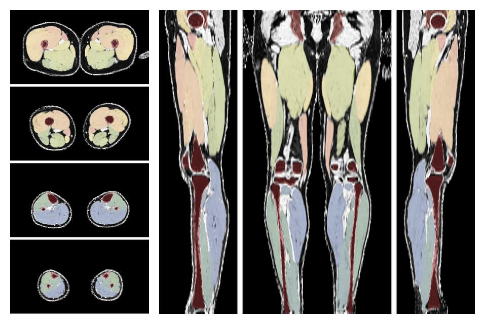 Overlay of automated muscle segmentation labels on dixon water image.