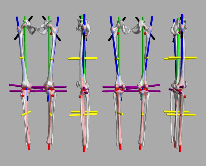 3D render of automated bone segmentation and force lines.