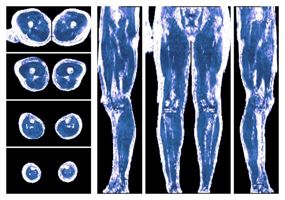 IVIM corrected whole leg muscle fractional anisotropy obtained from diffusion tensor imaging.