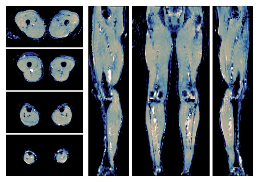 IVIM corrected whole leg muscle mean diffusivity obtained from diffusion tensor imaging.