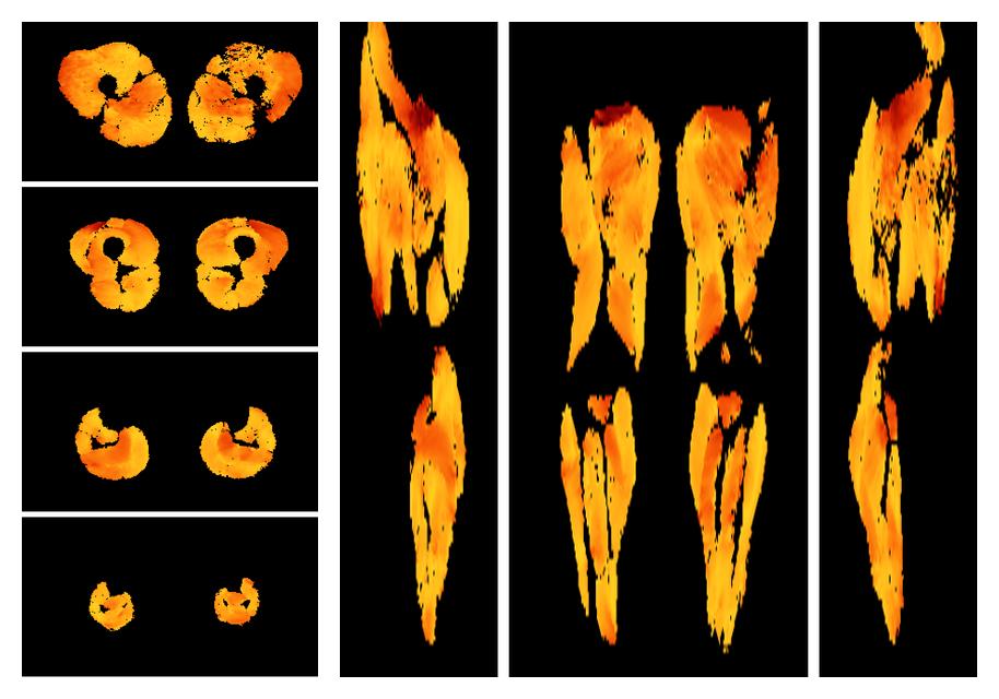 Muscle fiber tract angle map based on whole leg DTI based fiber tractography.