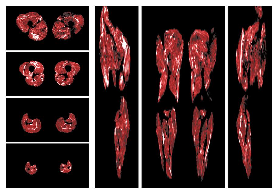 Muscle fiber tract density map based on whole leg DTI based fiber tractography.