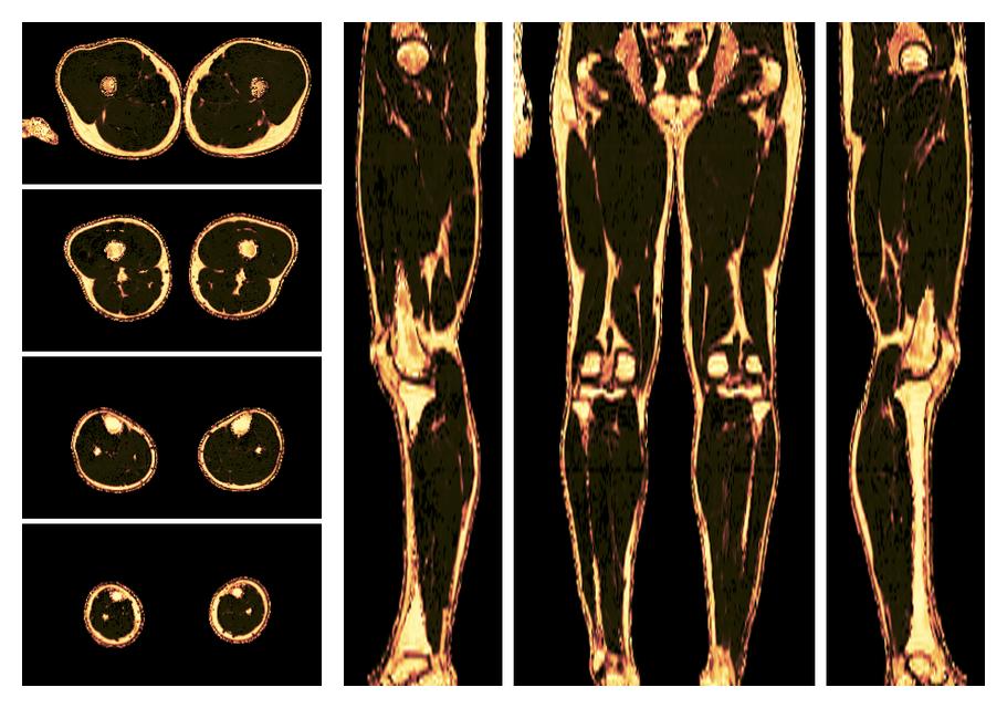 The fat fraction of the lower extremity obtained from the dixon reconstruction for muscle water fat quantification.