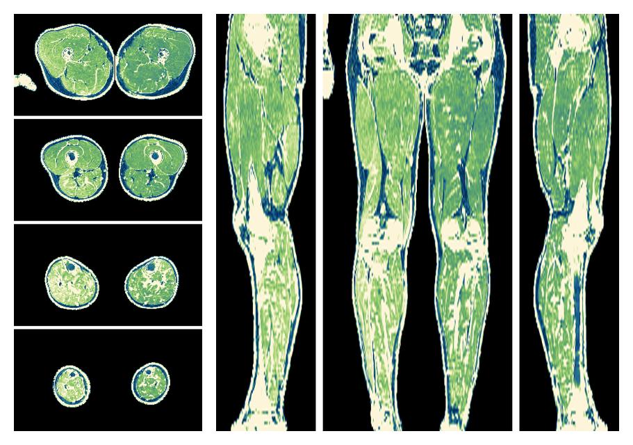 The R2 star relaxation time of the lower extremity obtained from the dixon reconstruction for muscle water fat quantification.