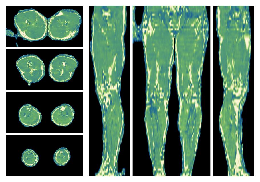 The water only T2 relaxation time of the lower extremity obtained from multi echo spin echo t2 mapping with EPG based reconstruction.