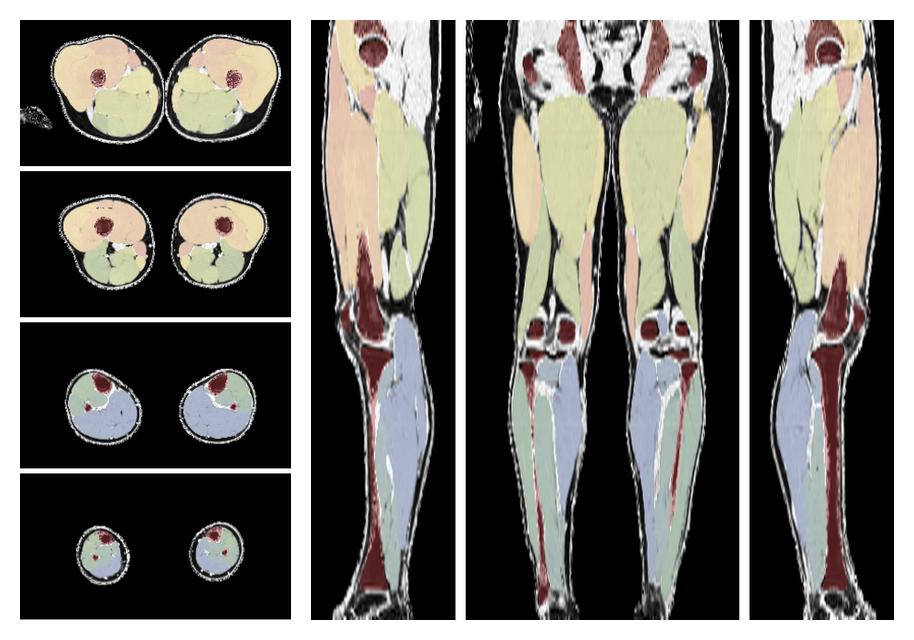 Overlay of automated muscle segmentation labels on dixon water image.