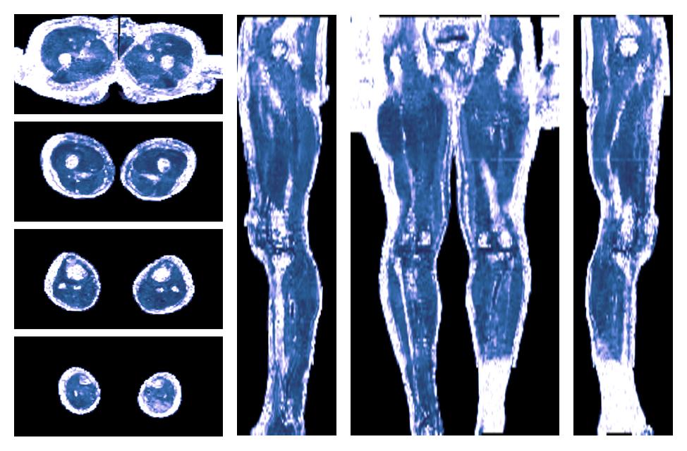 IVIM corrected whole leg muscle fractional anisotropy obtained from diffusion tensor imaging.