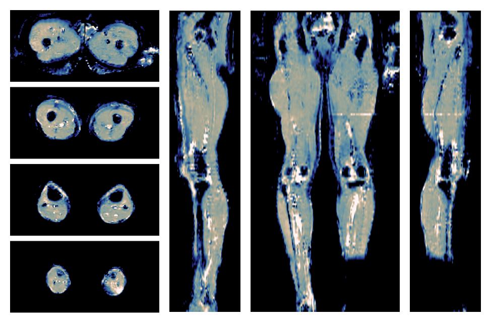 IVIM corrected whole leg muscle mean diffusivity obtained from diffusion tensor imaging.