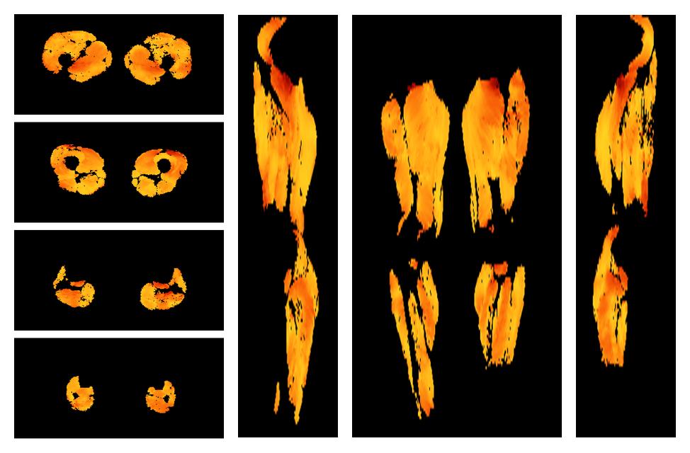 Muscle fiber tract angle map based on whole leg DTI based fiber tractography.