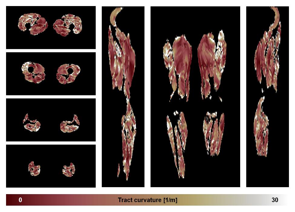 Muscle fiber tract curvature map based on whole leg DTI based fiber tractography.