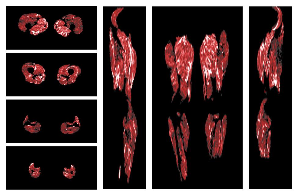 Muscle fiber tract density map based on whole leg DTI based fiber tractography.