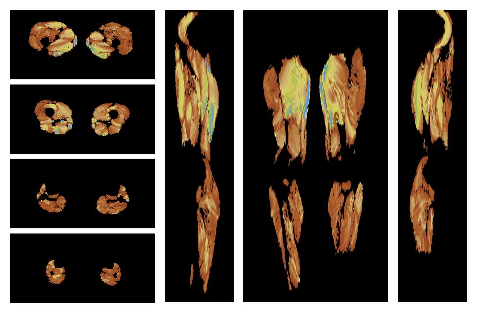 Muscle fiber tract length map based on whole leg DTI based fiber tractography.