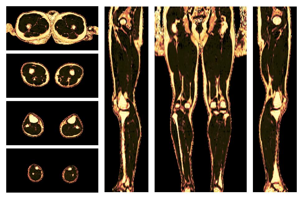 The fat fraction of the lower extremity obtained from the dixon reconstruction for muscle water fat quantification.