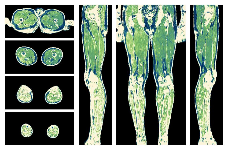 The R2 star relaxation time of the lower extremity obtained from the dixon reconstruction for muscle water fat quantification.