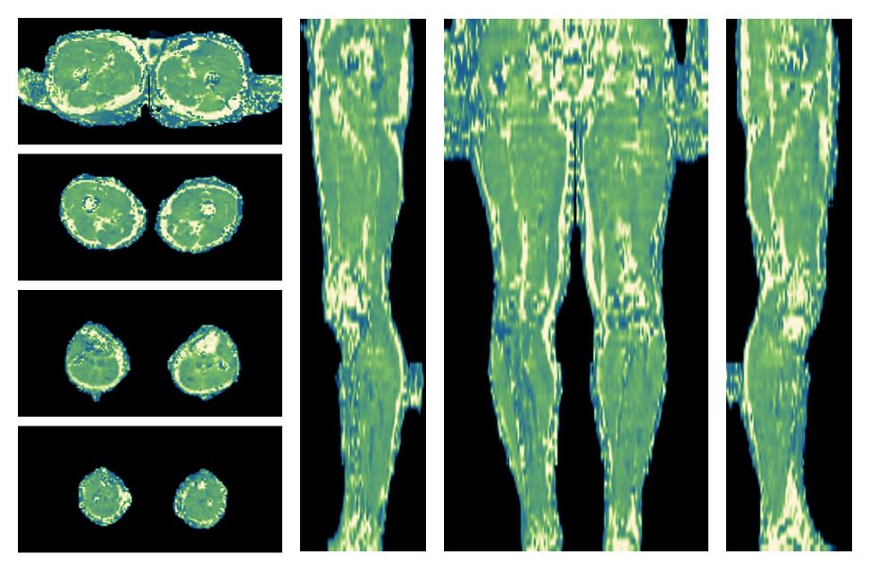 The water only T2 relaxation time of the lower extremity obtained from multi echo spin echo t2 mapping with EPG based reconstruction.