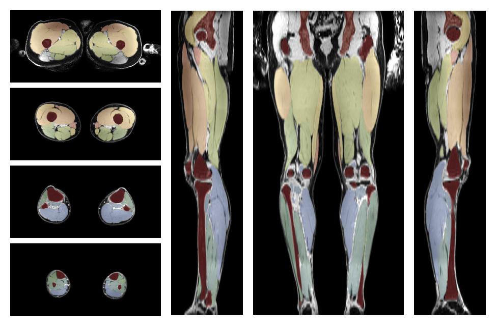 Overlay of automated muscle segmentation labels on dixon water image.