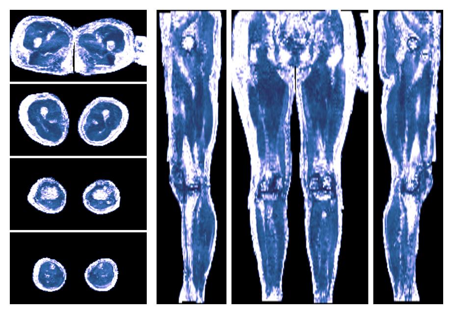 IVIM corrected whole leg muscle fractional anisotropy obtained from diffusion tensor imaging.