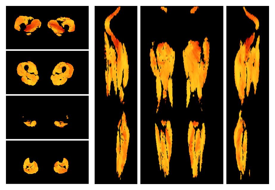 Muscle fiber tract angle map based on whole leg DTI based fiber tractography.