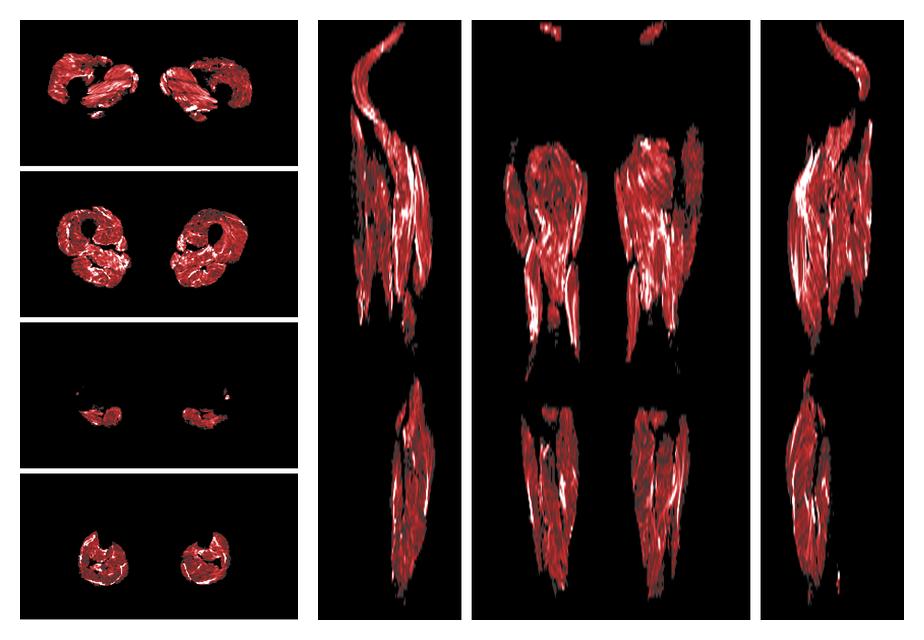 Muscle fiber tract density map based on whole leg DTI based fiber tractography.