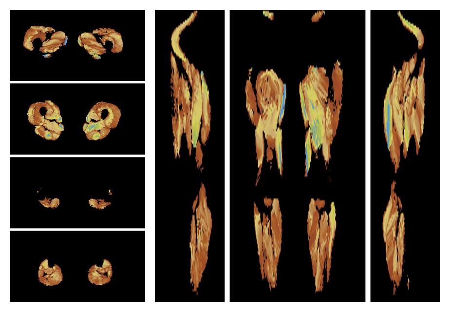 Muscle fiber tract length map based on whole leg DTI based fiber tractography.