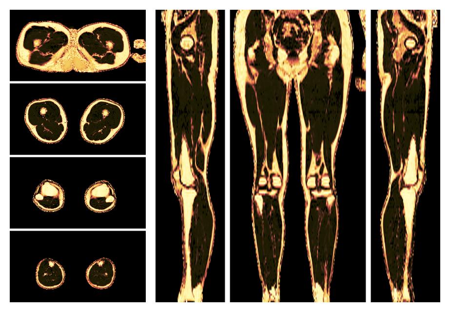 The fat fraction of the lower extremity obtained from the dixon reconstruction for muscle water fat quantification.