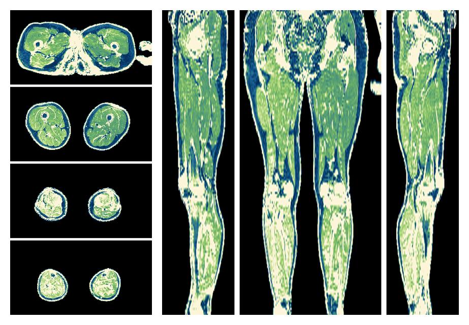 The R2 star relaxation time of the lower extremity obtained from the dixon reconstruction for muscle water fat quantification.