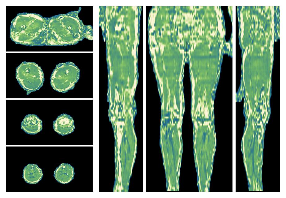 The water only T2 relaxation time of the lower extremity obtained from multi echo spin echo t2 mapping with EPG based reconstruction.