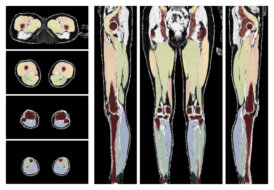 Overlay of automated muscle segmentation labels on dixon water image.