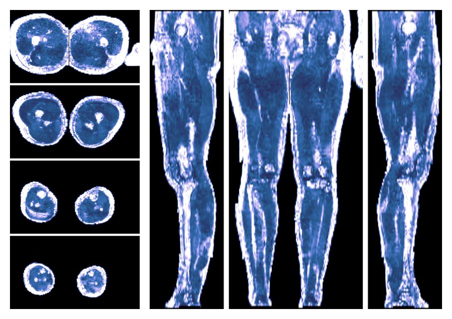 IVIM corrected whole leg muscle fractional anisotropy obtained from diffusion tensor imaging.