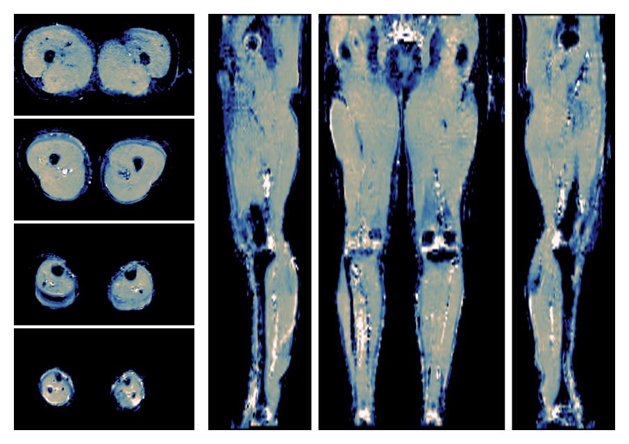 IVIM corrected whole leg muscle mean diffusivity obtained from diffusion tensor imaging.