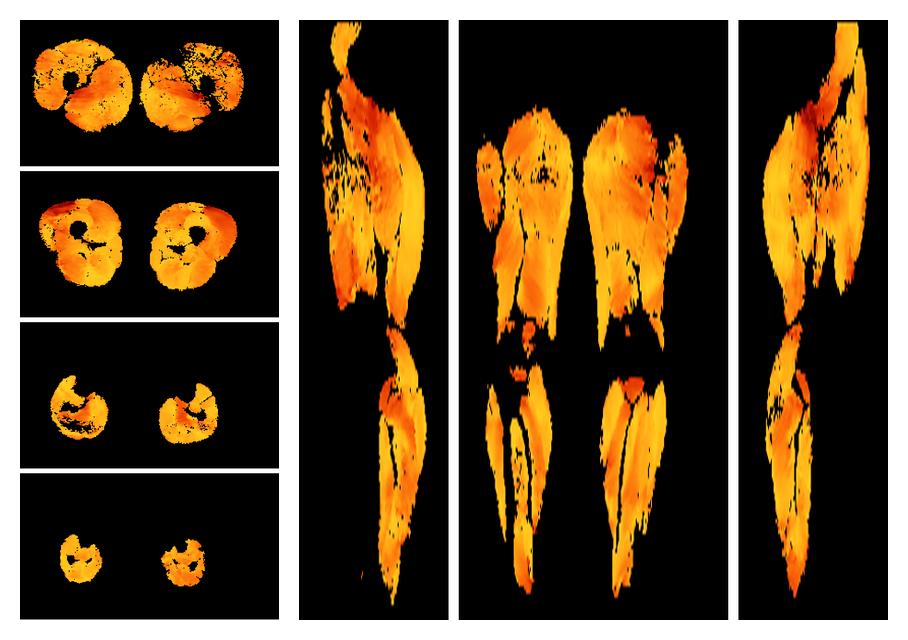 Muscle fiber tract angle map based on whole leg DTI based fiber tractography.