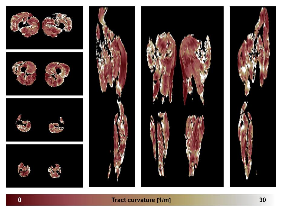 Muscle fiber tract curvature map based on whole leg DTI based fiber tractography.