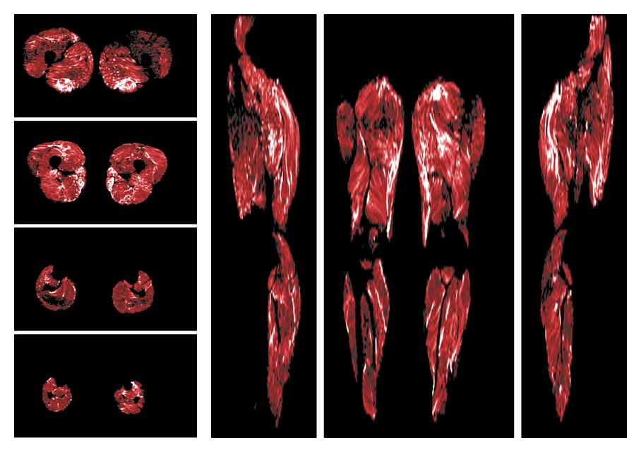 Muscle fiber tract density map based on whole leg DTI based fiber tractography.