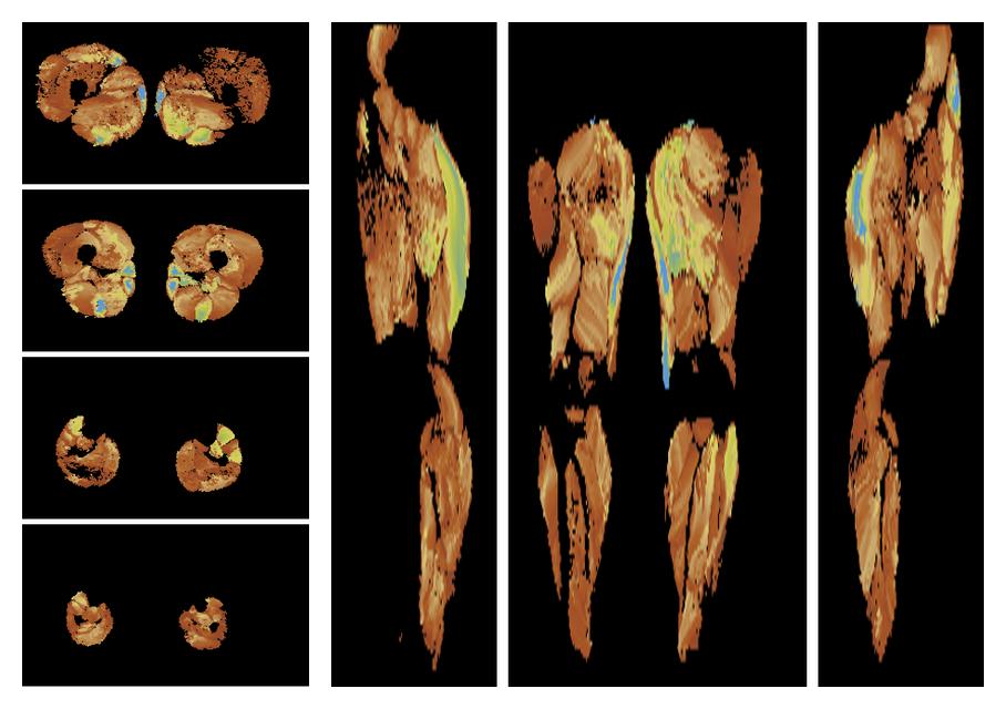 Muscle fiber tract length map based on whole leg DTI based fiber tractography.