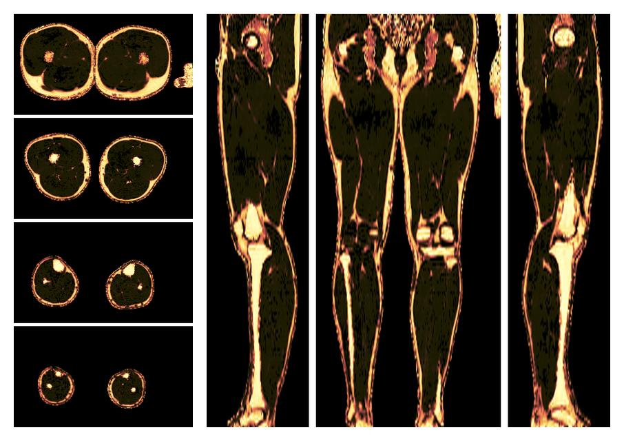 The fat fraction of the lower extremity obtained from the dixon reconstruction for muscle water fat quantification.