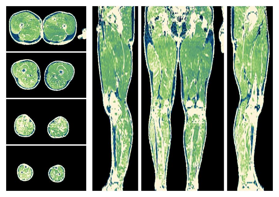 The R2 star relaxation time of the lower extremity obtained from the dixon reconstruction for muscle water fat quantification.