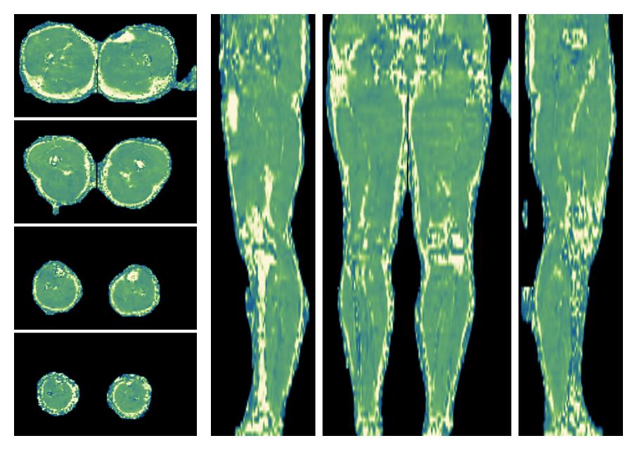 The water only T2 relaxation time of the lower extremity obtained from multi echo spin echo t2 mapping with EPG based reconstruction.