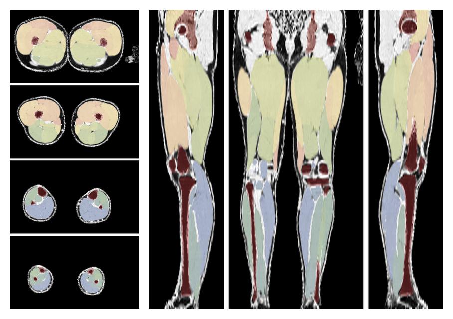 Overlay of automated muscle segmentation labels on dixon water image.