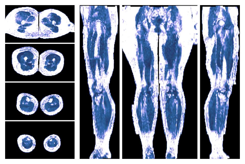 IVIM corrected whole leg muscle fractional anisotropy obtained from diffusion tensor imaging.