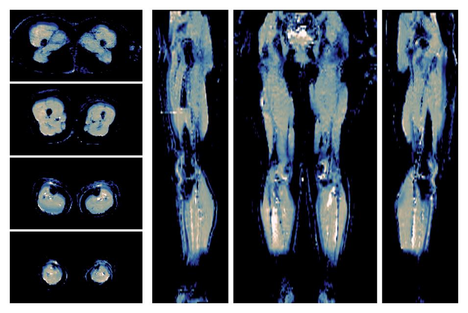 IVIM corrected whole leg muscle mean diffusivity obtained from diffusion tensor imaging.