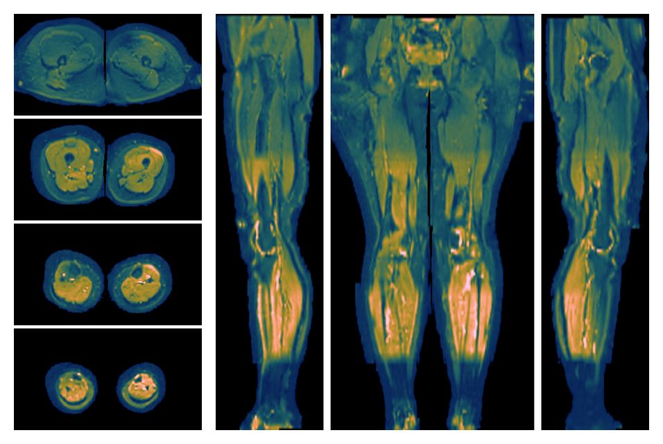 SNR distribution of the unweighted diffusion data.